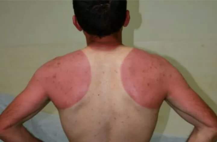 Summer is coming: Yanlış güneşlenmenin 10 ibretlik sonucu