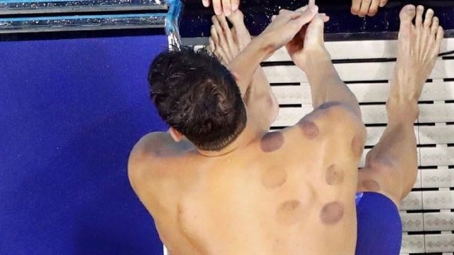 Rio Olimpiyatları'nda rekorları altüst eden Michael Phelps'in omuzundaki ve sırtındaki lekeler dikkat çekmişti.
