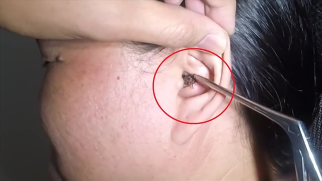 Uykusunda kulağına giren hamam böceği böyle çıkarıldı