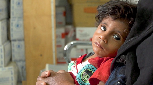 Yemen'de 130 bin çocuk tedavi altında