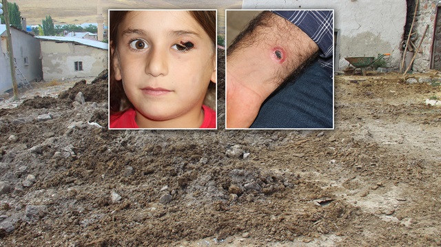 Şarbon bulaşan ineğin etinin yiyen baba ve kızın vücudunda yaralar çıktı.