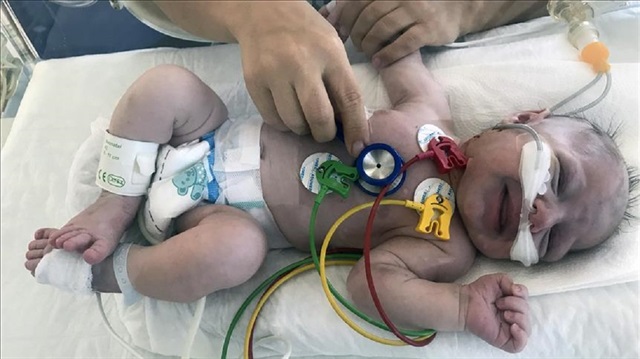 Doğumunun ikinci gününde nefes almakta zorlanan ve vücudu moraran bebeğe stent takıldı.