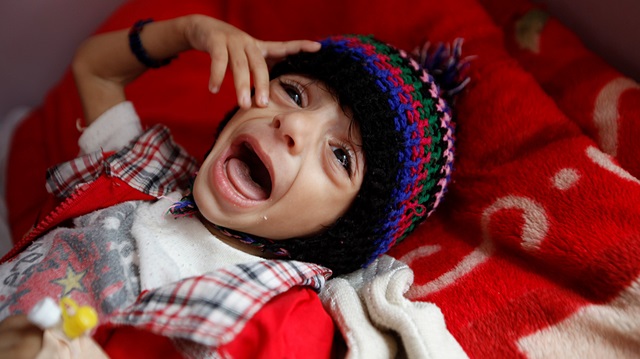A boy cries at a hospital malnutrition intensive care unit in Sanaa, Yemen.