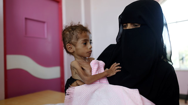 Yemende milyonlar açlıktan ölüyor