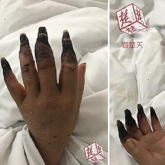 Elindeki ufak kesik nedeniyle 8 parmağını birden kaybediyordu