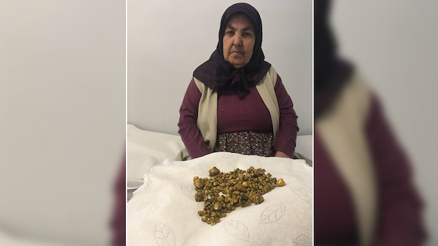 Safra kesesinden 311 tane taş çıktı