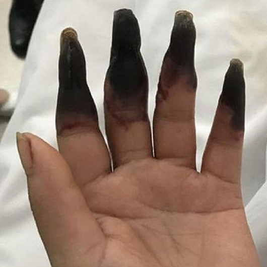 Kaptığı amip hayatını kararttı