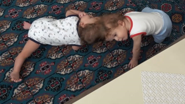 Kafadan yapışık siyam ikizleri 1 yaşında