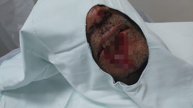 Kayınpederinin dudağını ısırarak parçalayan damat tutuklandı