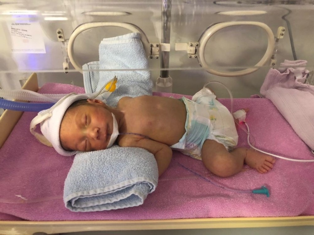 Two-headed Syrian baby born in Turkey’s south